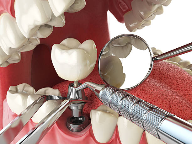 Best Urgent Care for Lost Fillings or Crowns in New Milford, NJ